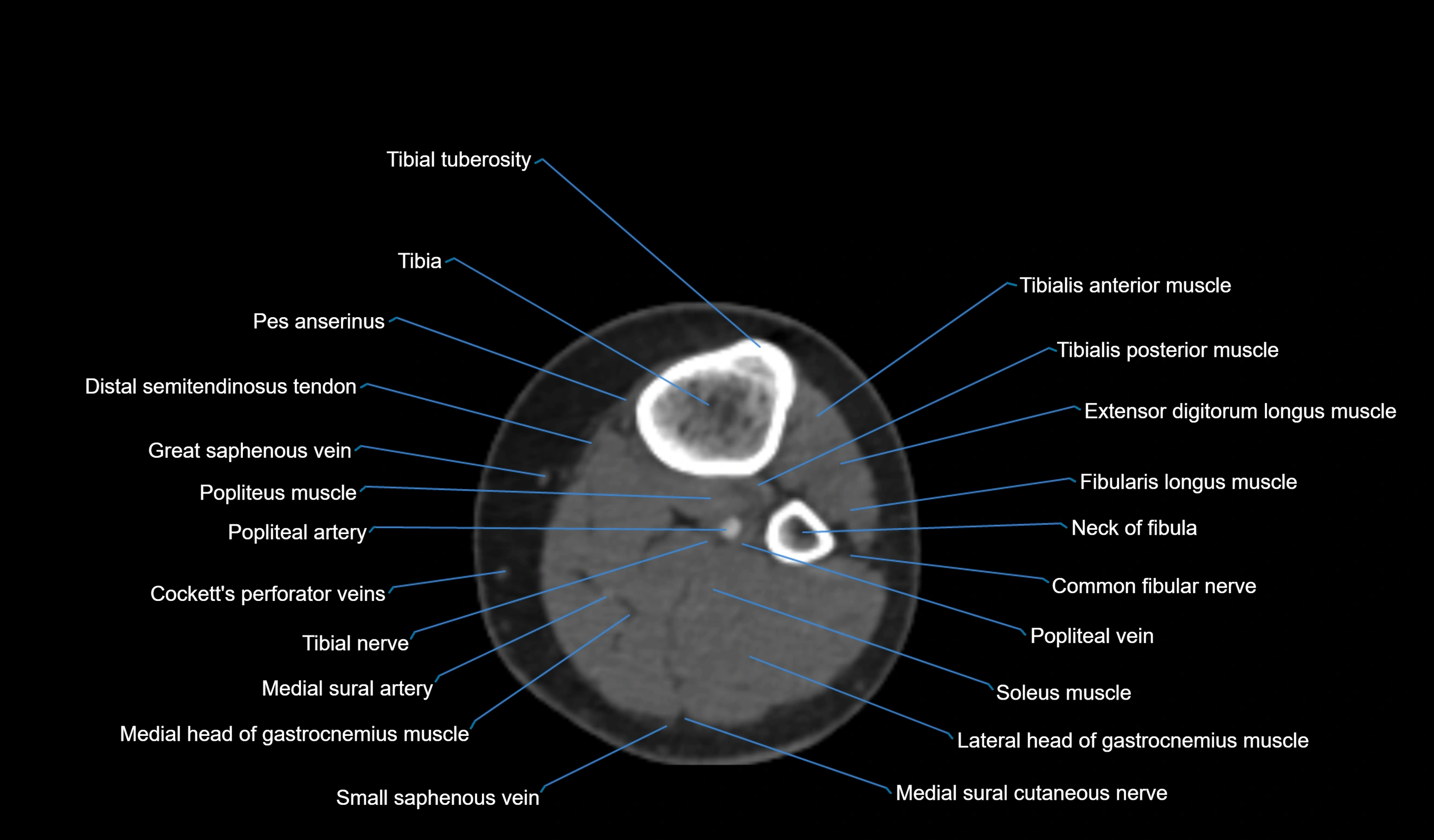 CT knee axial cross sectional anatomy labelled image-00052.webp